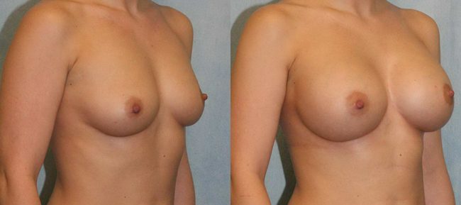 Breast Augmentation Patient 10 Image 3