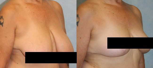 Breast Reduction Surgery Cost: Everything You Need to Know