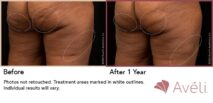 Avéli™ Cellulite Reduction Before and After Photo 2