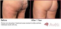 Avéli™ Cellulite Reduction Before and After Photo 4