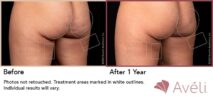 Avéli™ Cellulite Reduction Before and After Photo 5