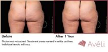 Avéli™ Cellulite Reduction Before and After Photo 6