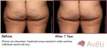 Avéli™ Cellulite Reduction Before and After Photo 16