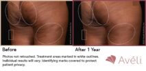 Avéli™ Cellulite Reduction Before and After Photo 15