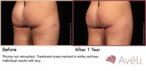 Avéli™ Cellulite Reduction Before and After Photo 0