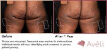 Avéli™ Cellulite Reduction Before and After Photo 18