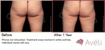 Avéli™ Cellulite Reduction Before and After Photo 17