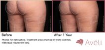 Avéli™ Cellulite Reduction Before and After Photo 3