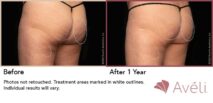 Avéli™ Cellulite Reduction Before and After Photo 10