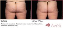 Avéli™ Cellulite Reduction Before and After Photo 9