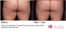 Avéli™ Cellulite Reduction Before and After Photo 14