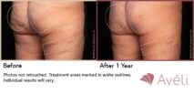 Avéli™ Cellulite Reduction Before and After Photo 13