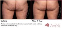 Avéli™ Cellulite Reduction Before and After Photo 12