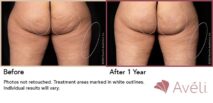 Avéli™ Cellulite Reduction Before and After Photo 1