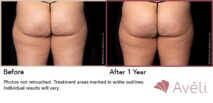 Avéli™ Cellulite Reduction Before and After Photo 11