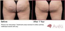 Avéli™ Cellulite Reduction Before and After Photo 8