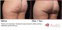 Avéli™ Cellulite Reduction Before and After Photo 7