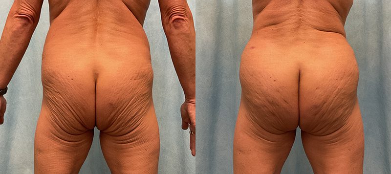 Body Contouring Patient 1 Image 4