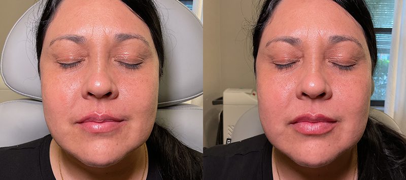 Dermal Filler Patient 3 Image 0