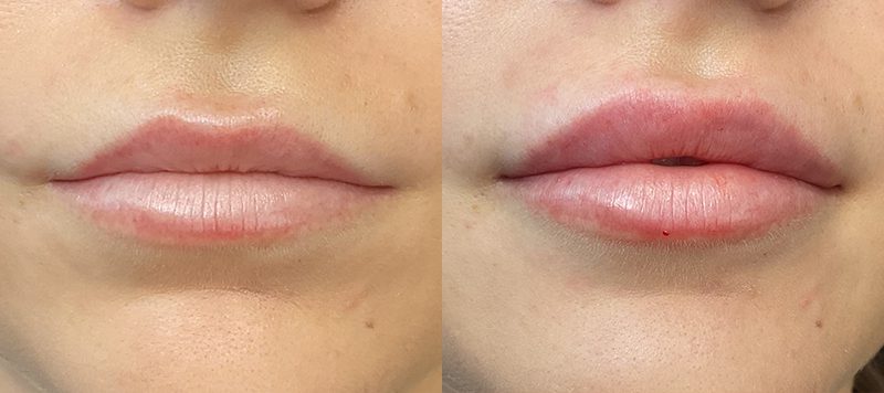 Lip Filler Patient 10 Image 0